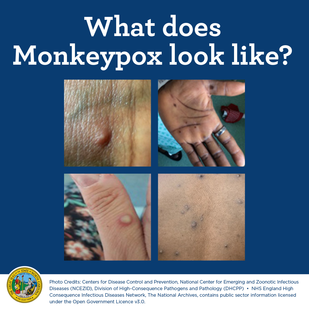 Monkeypox Pictures: How to Identify Symptoms of Monkeypox